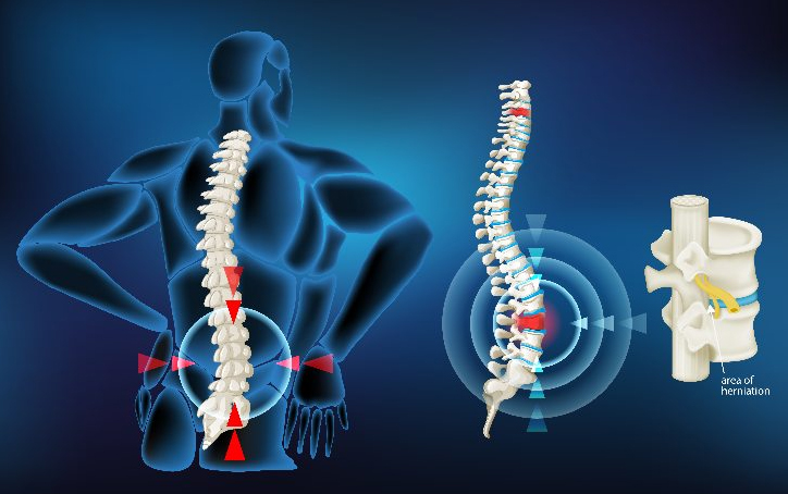 Disc Prolapse